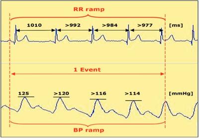 Association between ablation-induced baroreceptor reflex modification and procedure efficacy in patients with atrial fibrillation